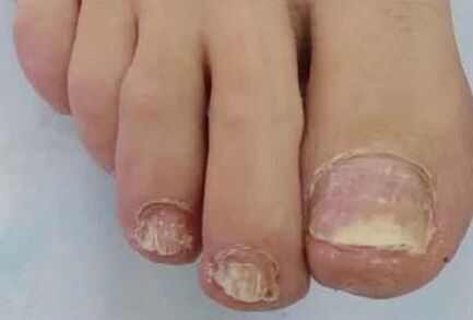 As uñas estaban moi afectadas polo cogomelo