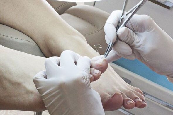 Eliminación mecánica de uñas afectadas por cogomelos