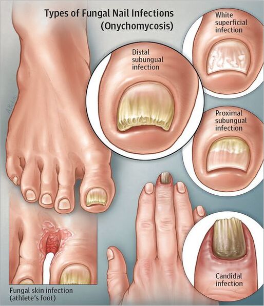 Tipos de onicomicosis
